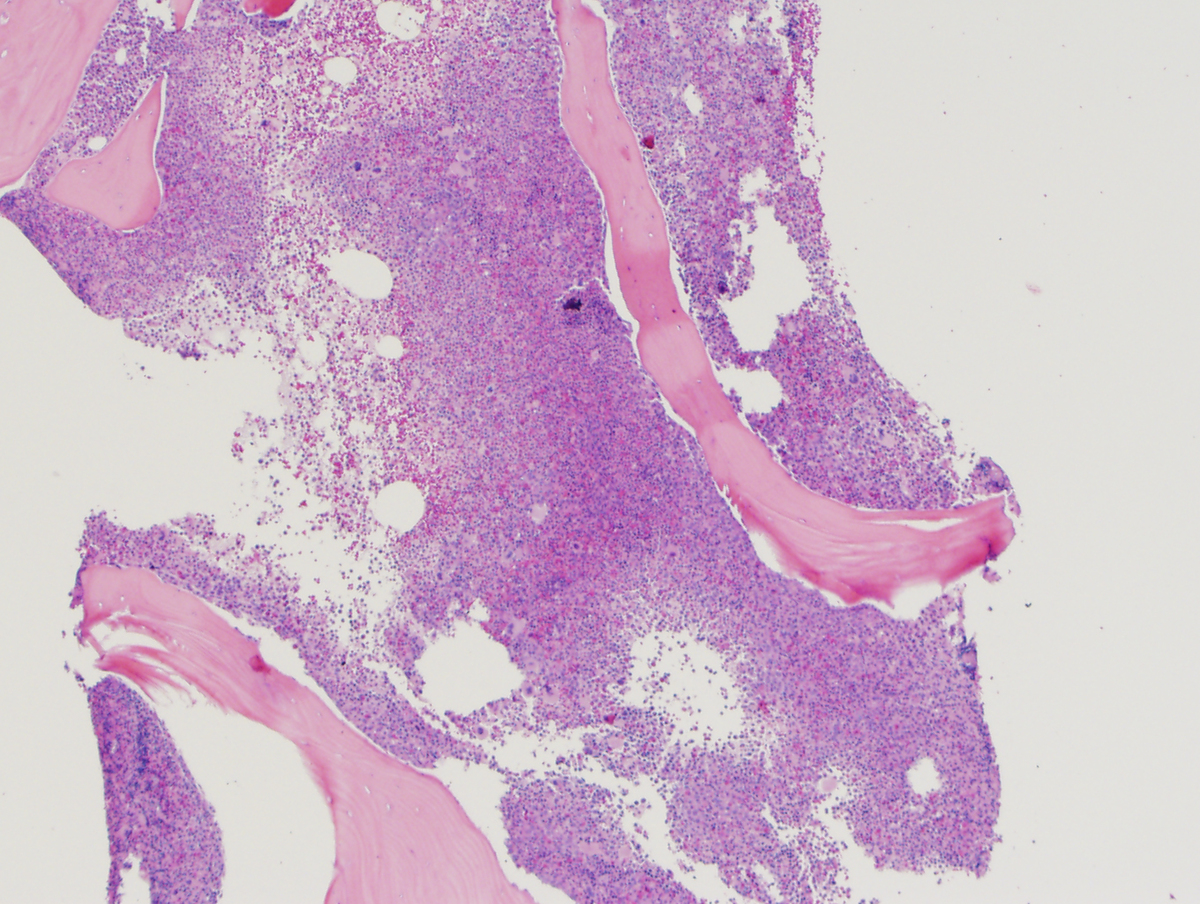 The biopsy was markedly hypercellular (>95% cellularity).
